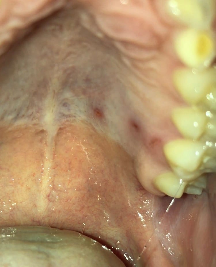 Gehemelte Gaatjes Medische Forum Dokter Nl
