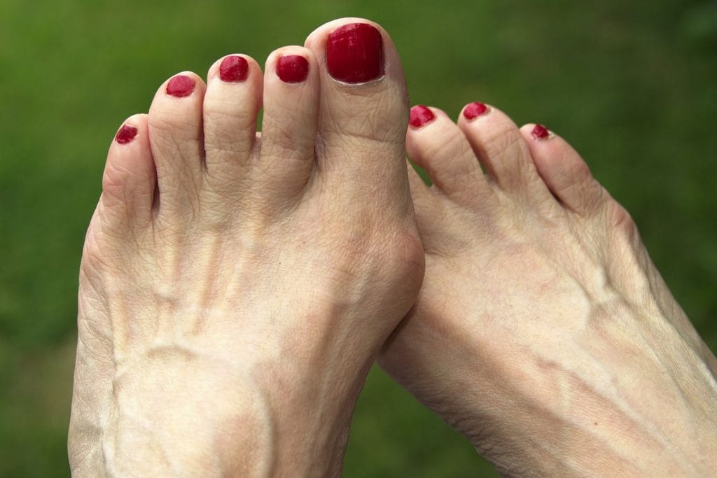 Hallux valgus, één van de meest voorkomende voetklachten