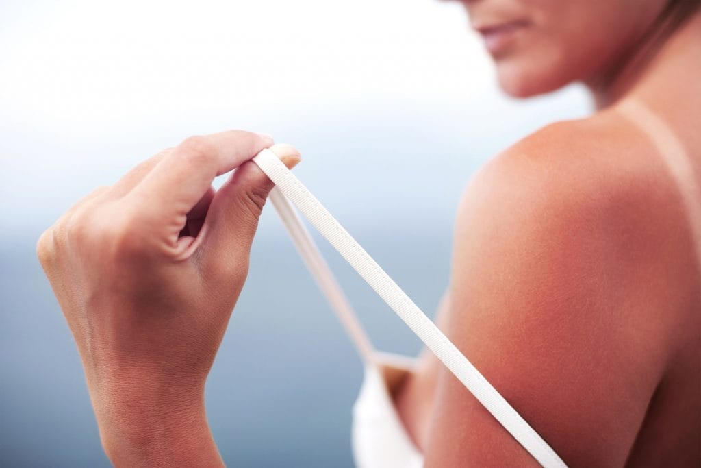 Verbrand door de zon is niet onschuldig