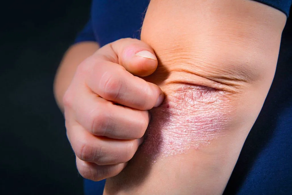 Heb jij last van psoriasis?