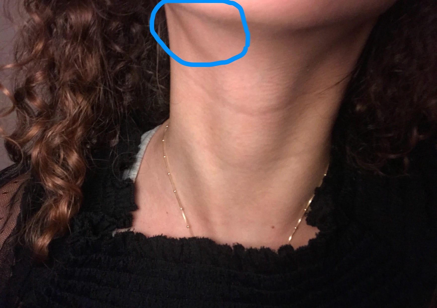 Opgezette klier? - Medische Forum - Dokter.nl