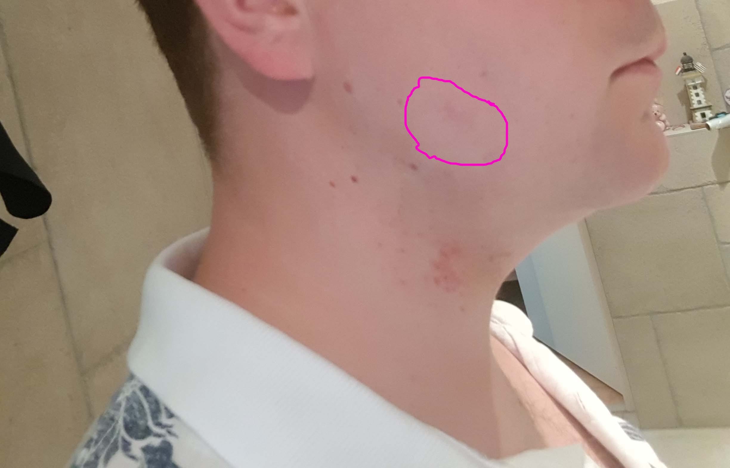 Ik Bijt Steeds Op Mijn Wang