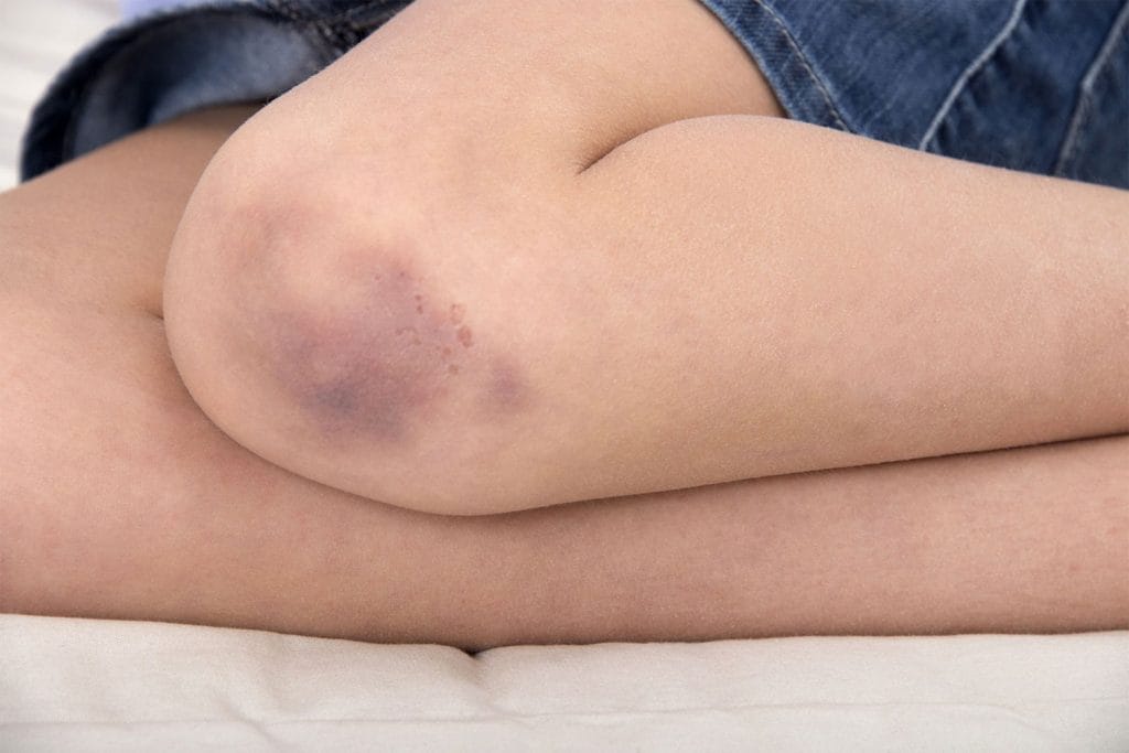 Leukemie, een ernstige en soms levensbedreigende ziekte