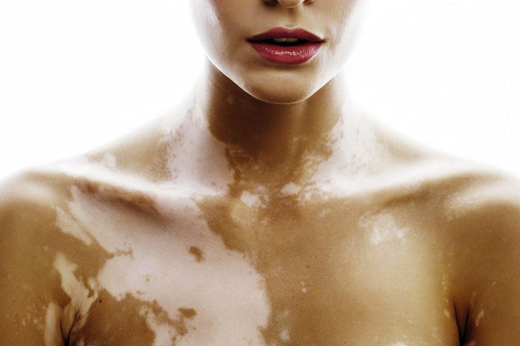 Vitiligo, wat is de oorzaak van deze huidaandoening?