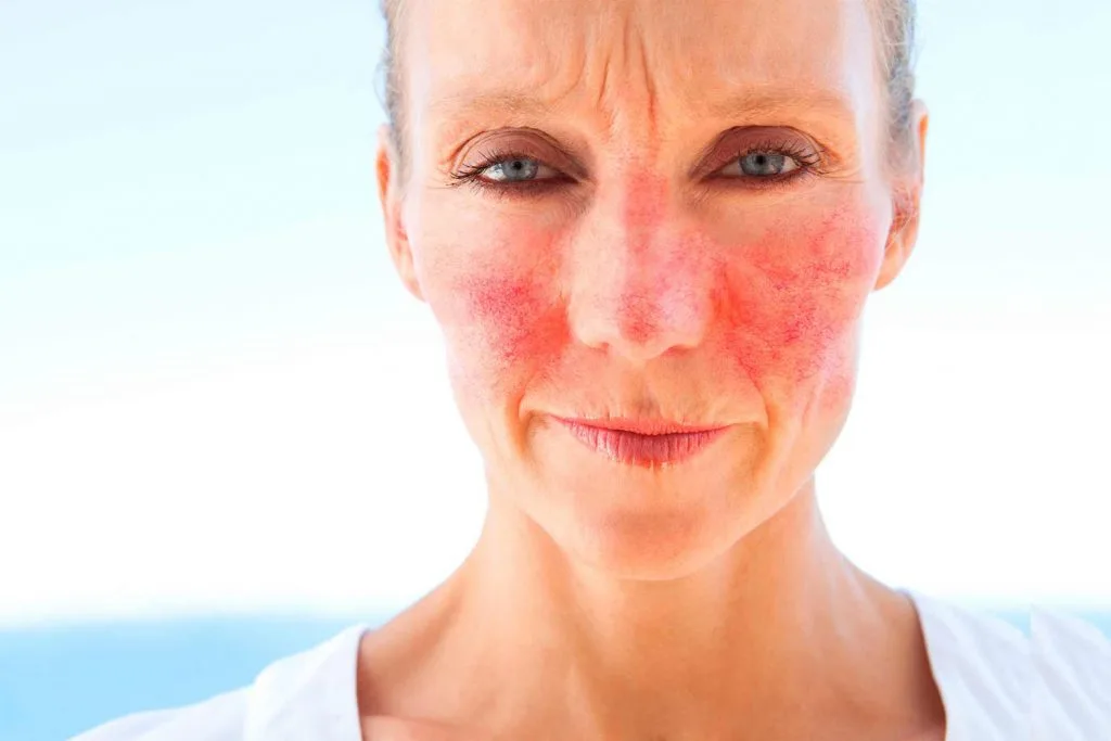 Wanneer je last hebt van rosacea