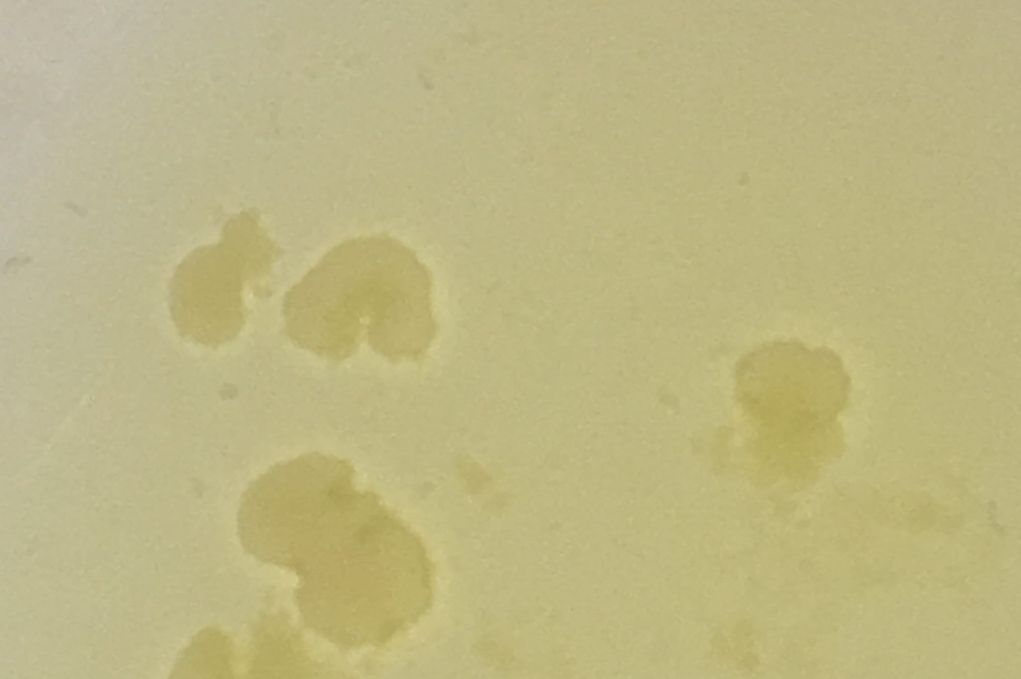 Waarom Zijn Er Leukocyten In Mijn Urine Medicaldiagcom