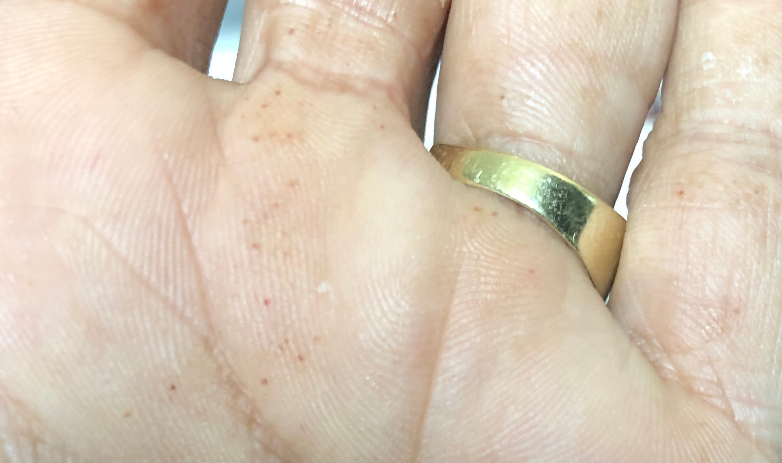 rode puntjes huid - DrBeckmann