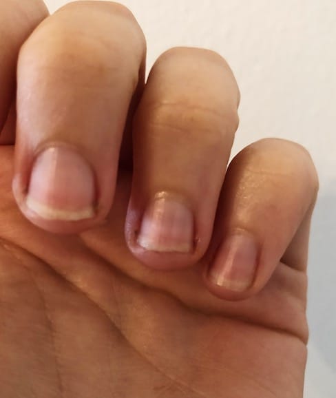 Horizontale Lijn Nagel Medische Forum Dokter Nl