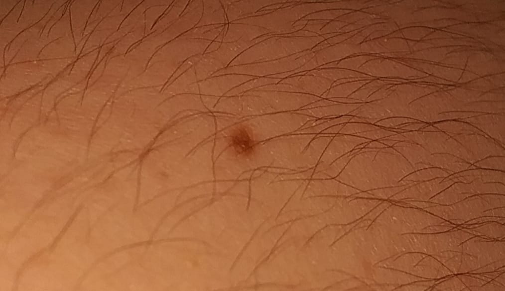 Controle moedervlek - Medische Forum - Dokter.nl