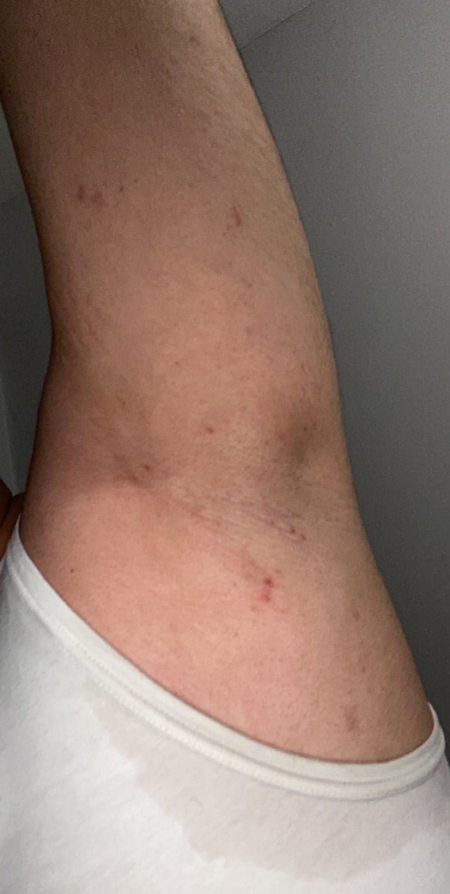 Oksel Lymfeklieren Medische Forum Dokter Nl