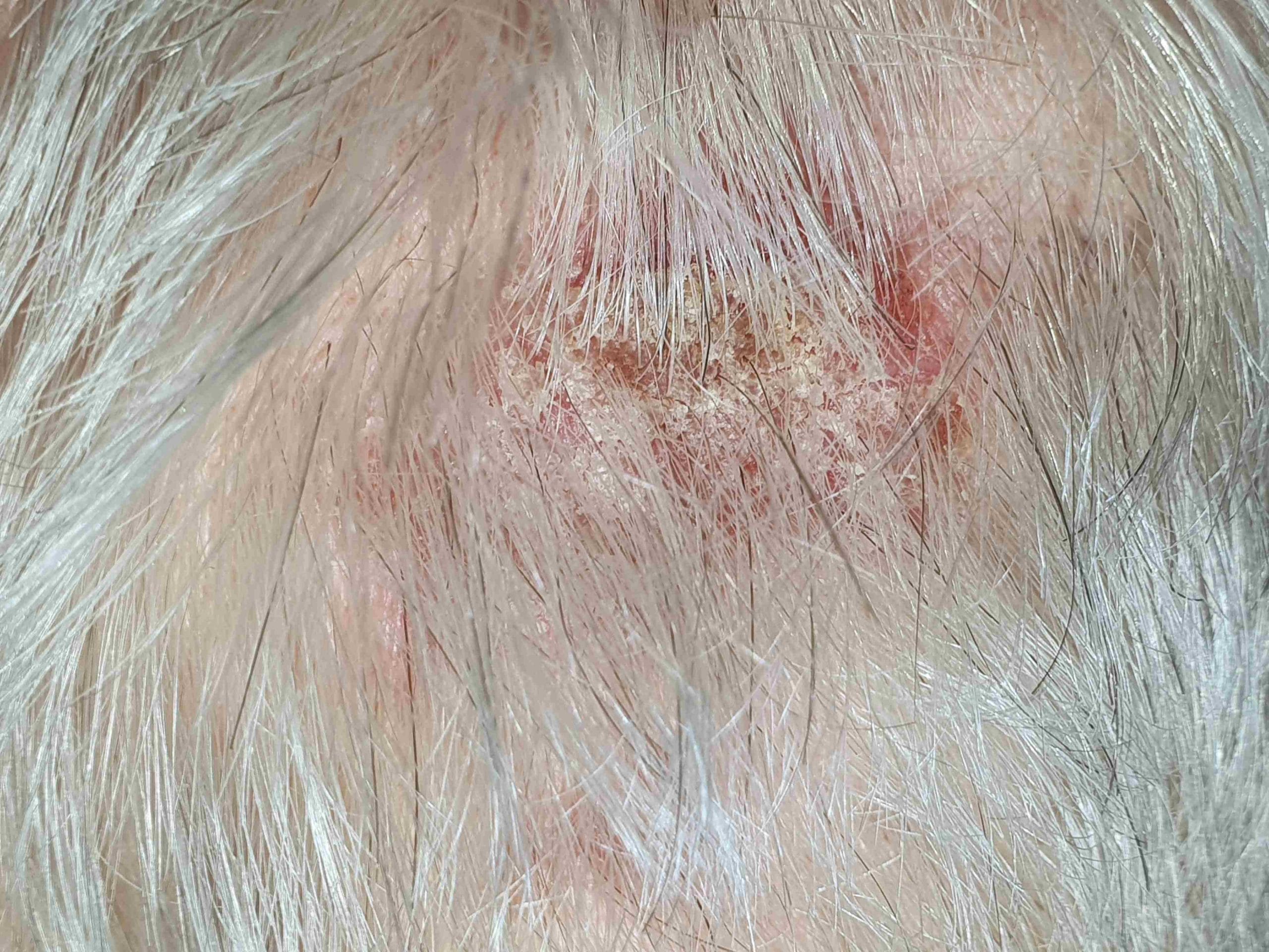 Hoofdhuid problemen - Medische Forum - Dokter.nl