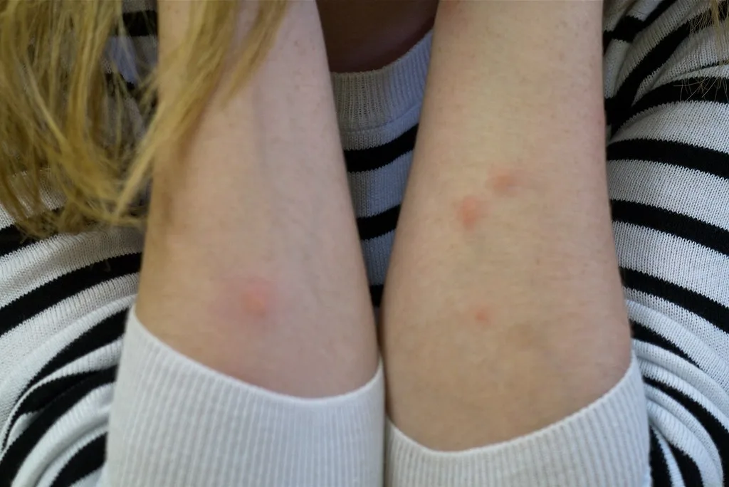 Insectenbeet, wat moet je wel en niet doen?