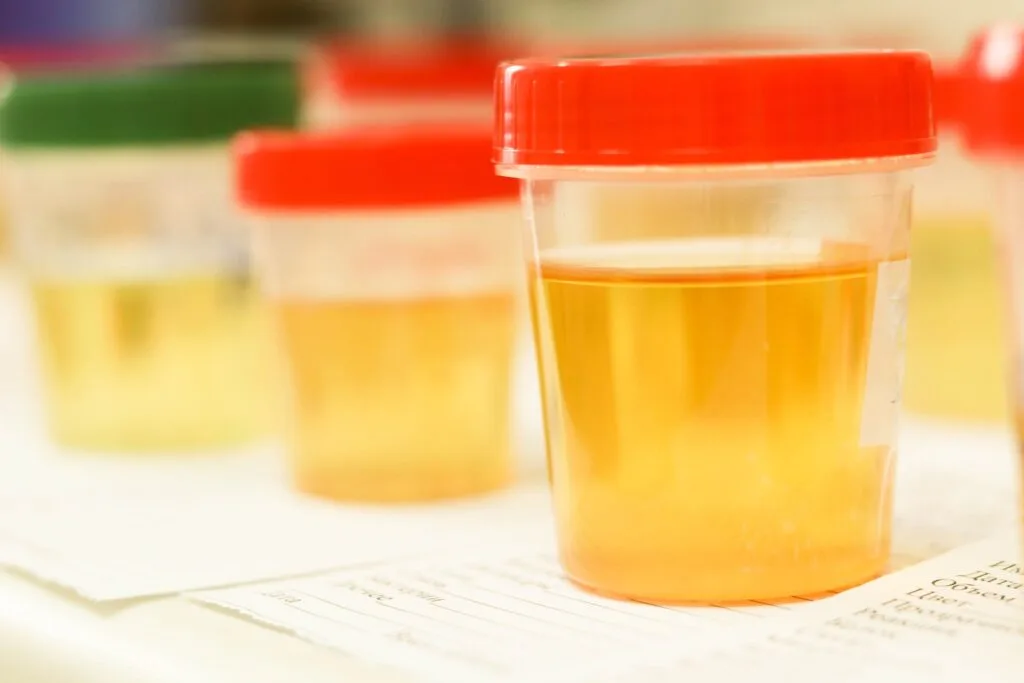 Oorzaken van bloed in urine