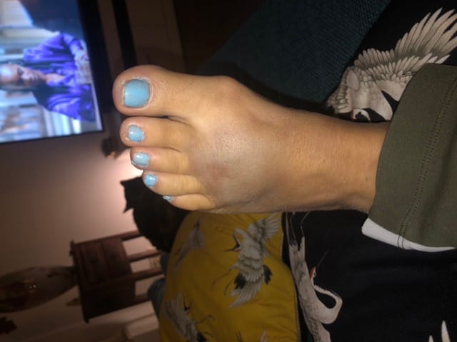 Blauwe plek ineens op voet in de sauna - Medische Forum - Dokter.nl