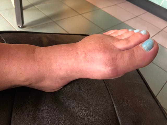 Ineens Blauwe Plek Onder Voet