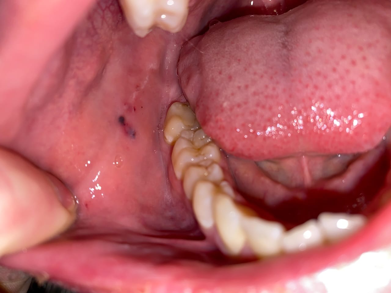 Paars/Zwarte vlekken binnenkant wang - Medische Forum - Dokter.nl