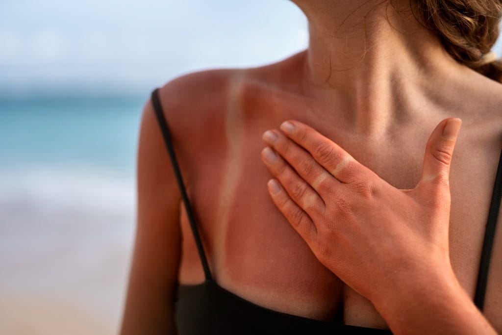 Verbranden door de zon, wat zijn de gevolgen?