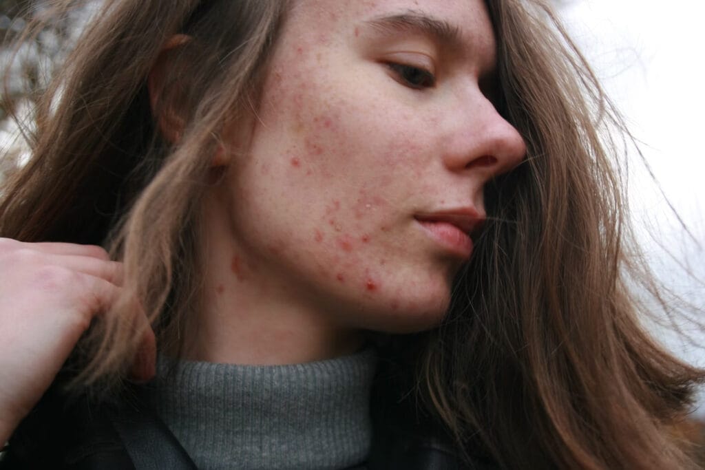 Acne: tips om het te bestrijden