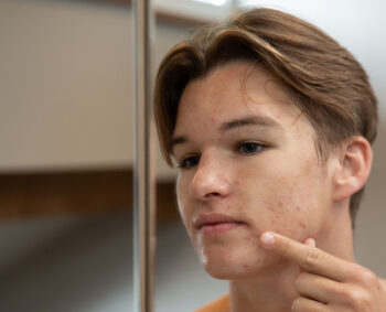 Bestaat er een quick fix voor acne?