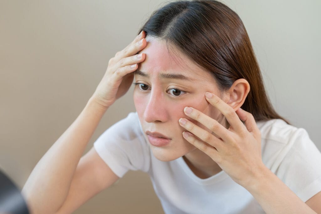 Rosacea; wat kun je daaraan doen?