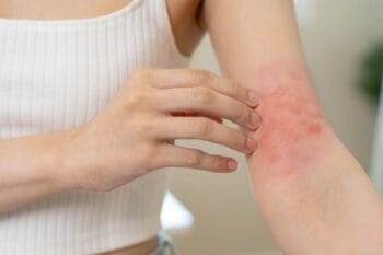 allergische reactie huid