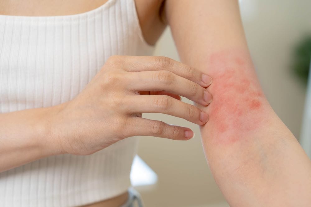 allergische reactie huid