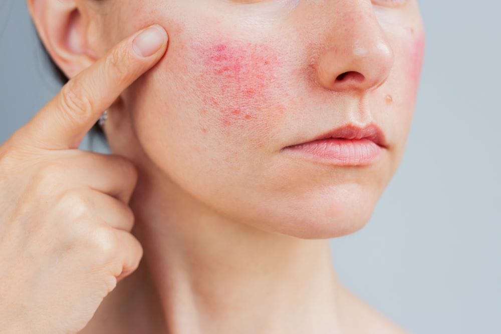 rosacea